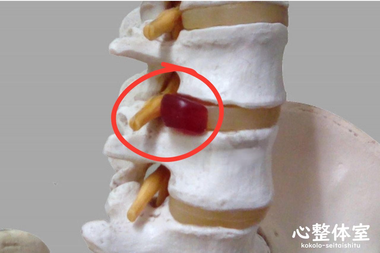 腰椎椎間板ヘルニア