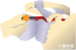 肩の脱臼で靭帯が緩む