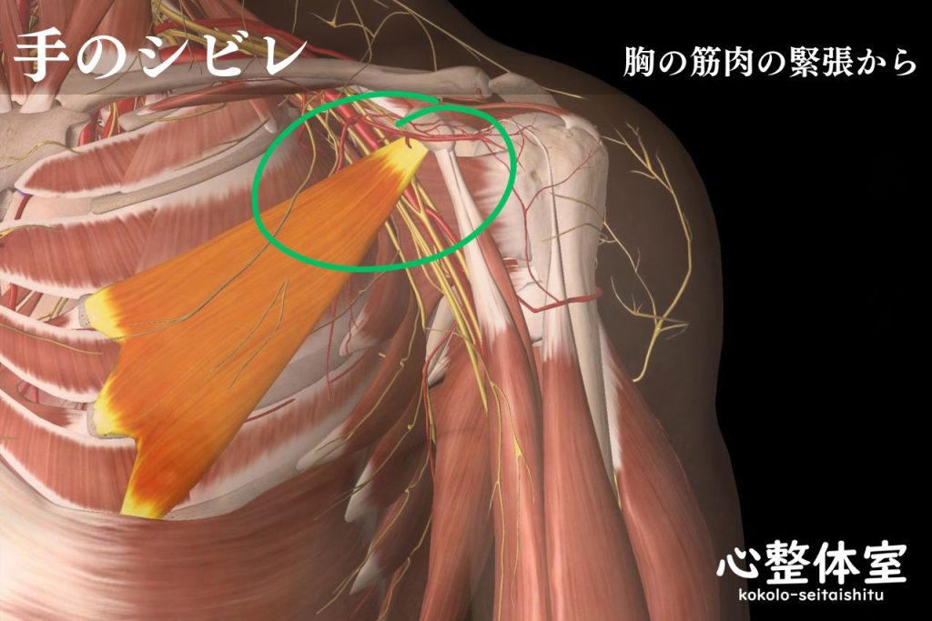 手のシビレは胸の筋肉が原因