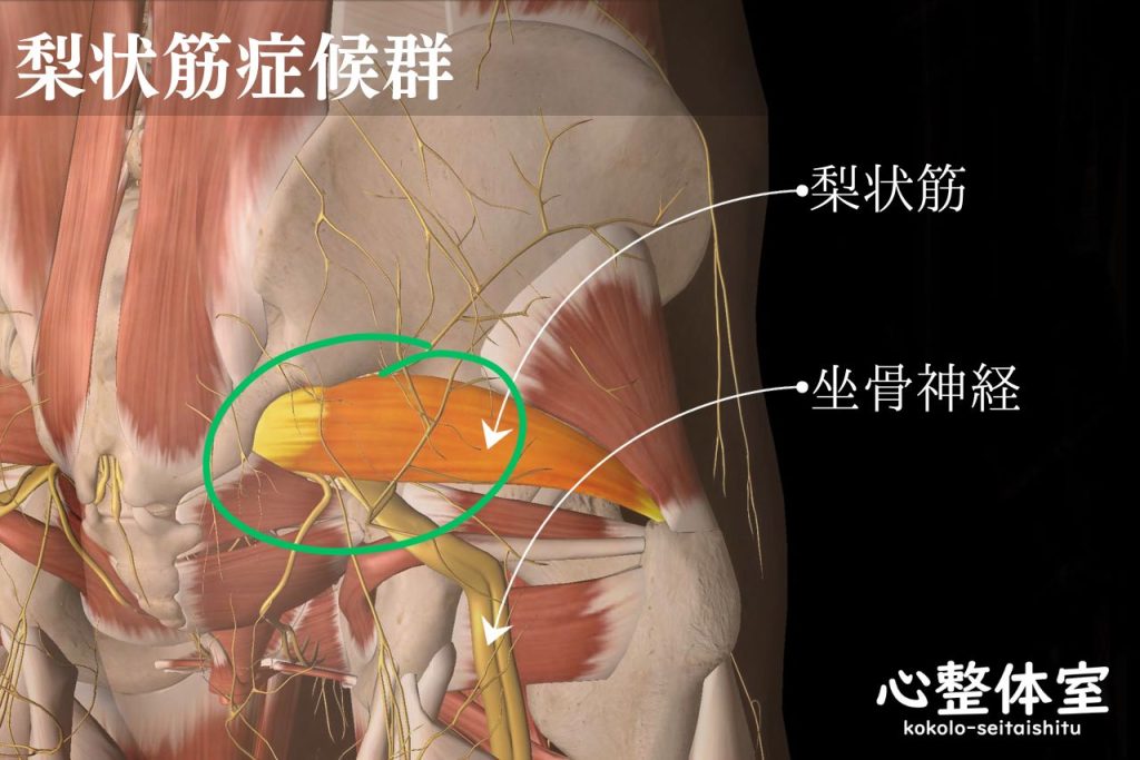 梨状筋症候群