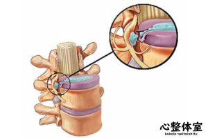 頚椎ヘルニア