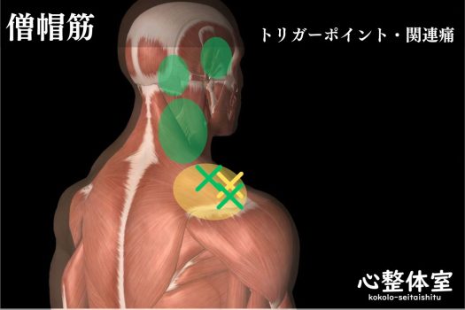 僧帽筋トリガーポイント関連痛01