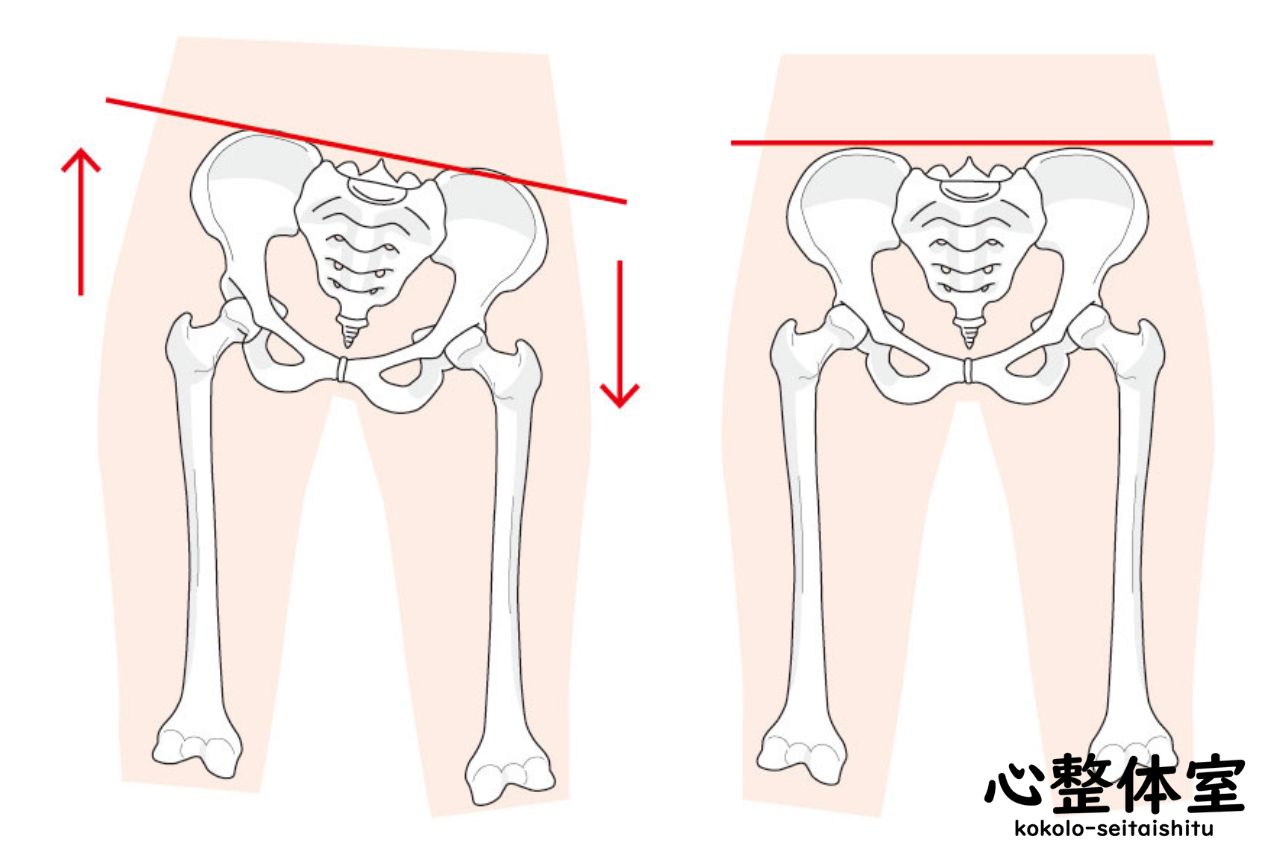 骨盤の歪み