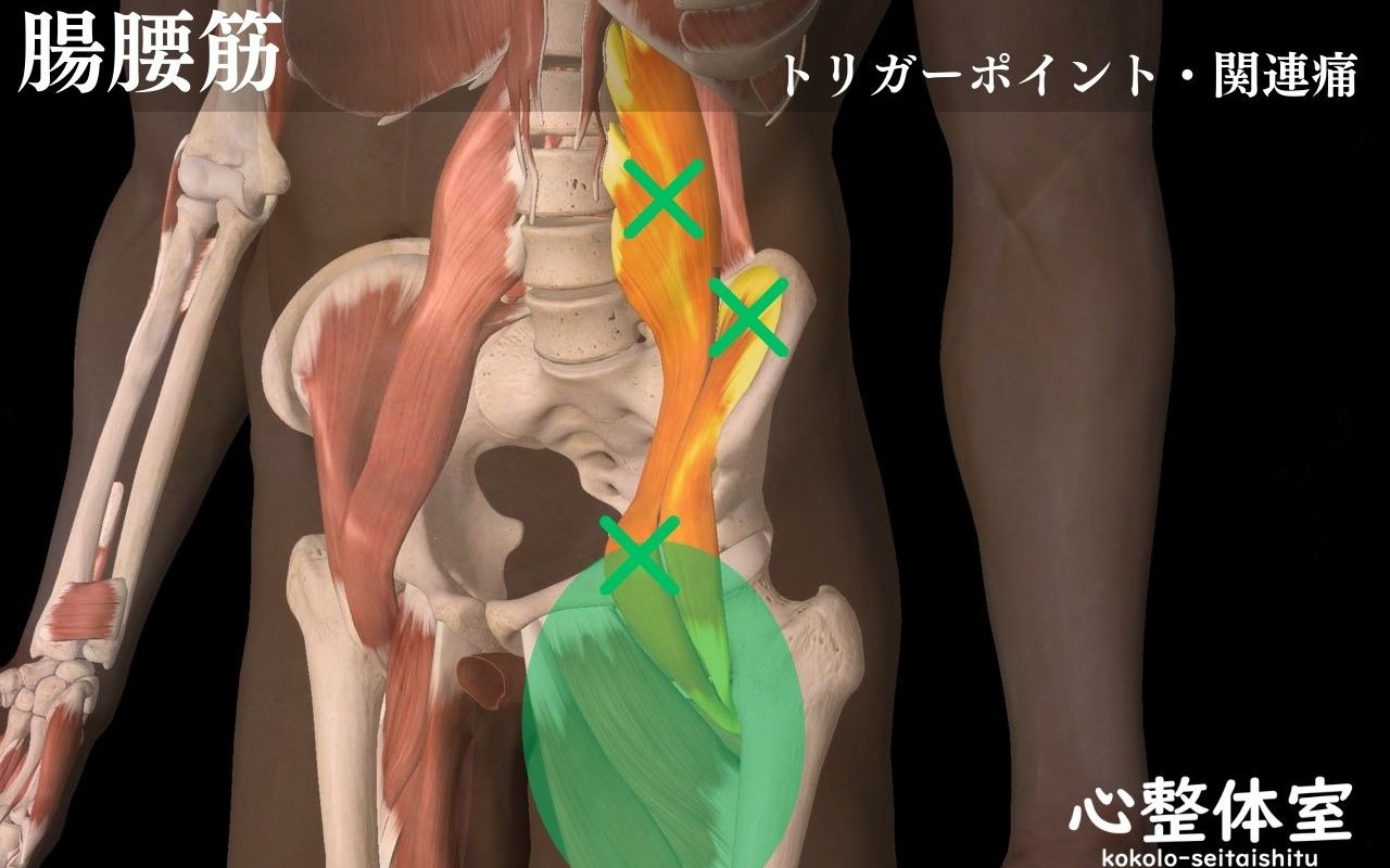 腸腰筋トリガーポイント01