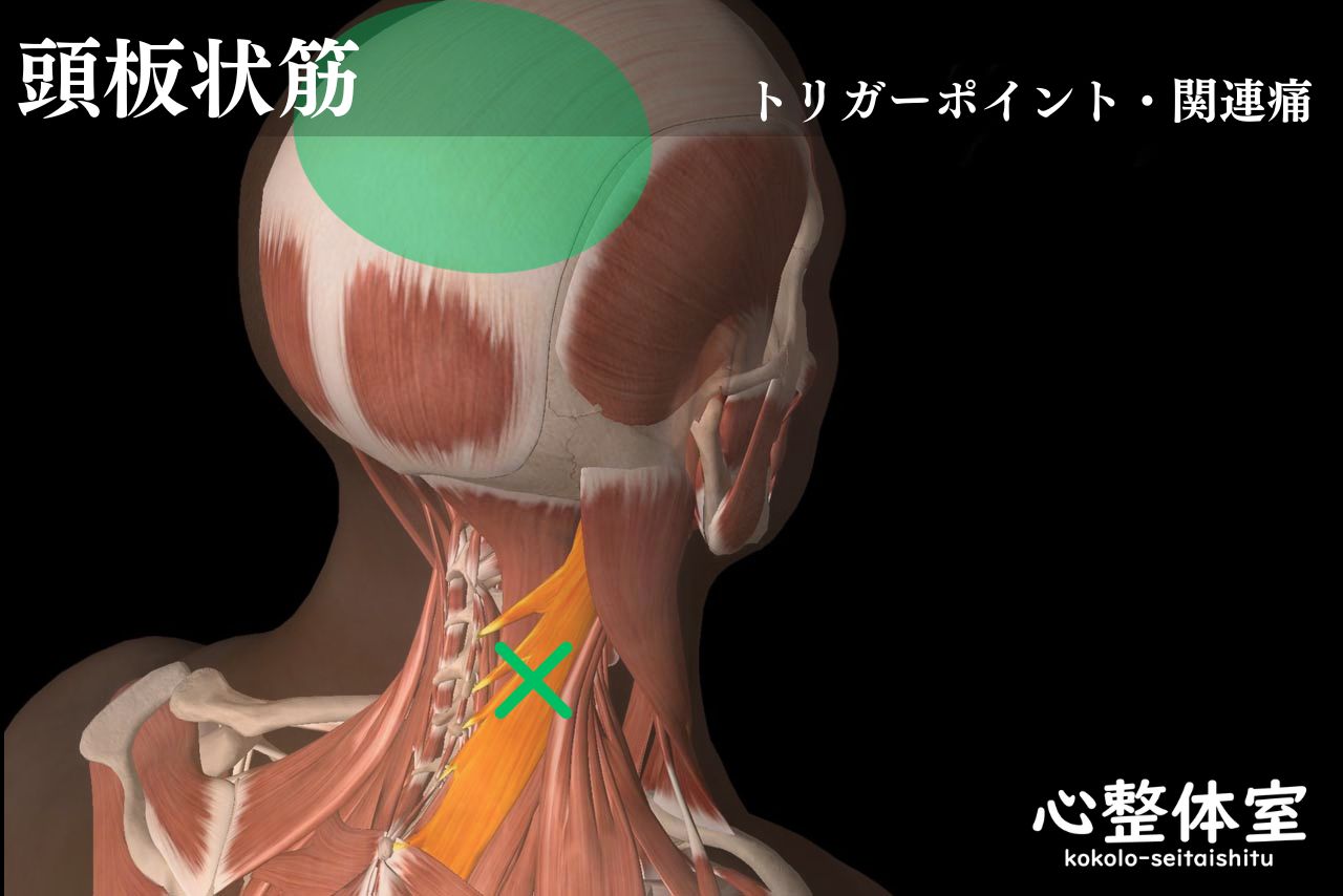 頭板状筋トリガーポイント