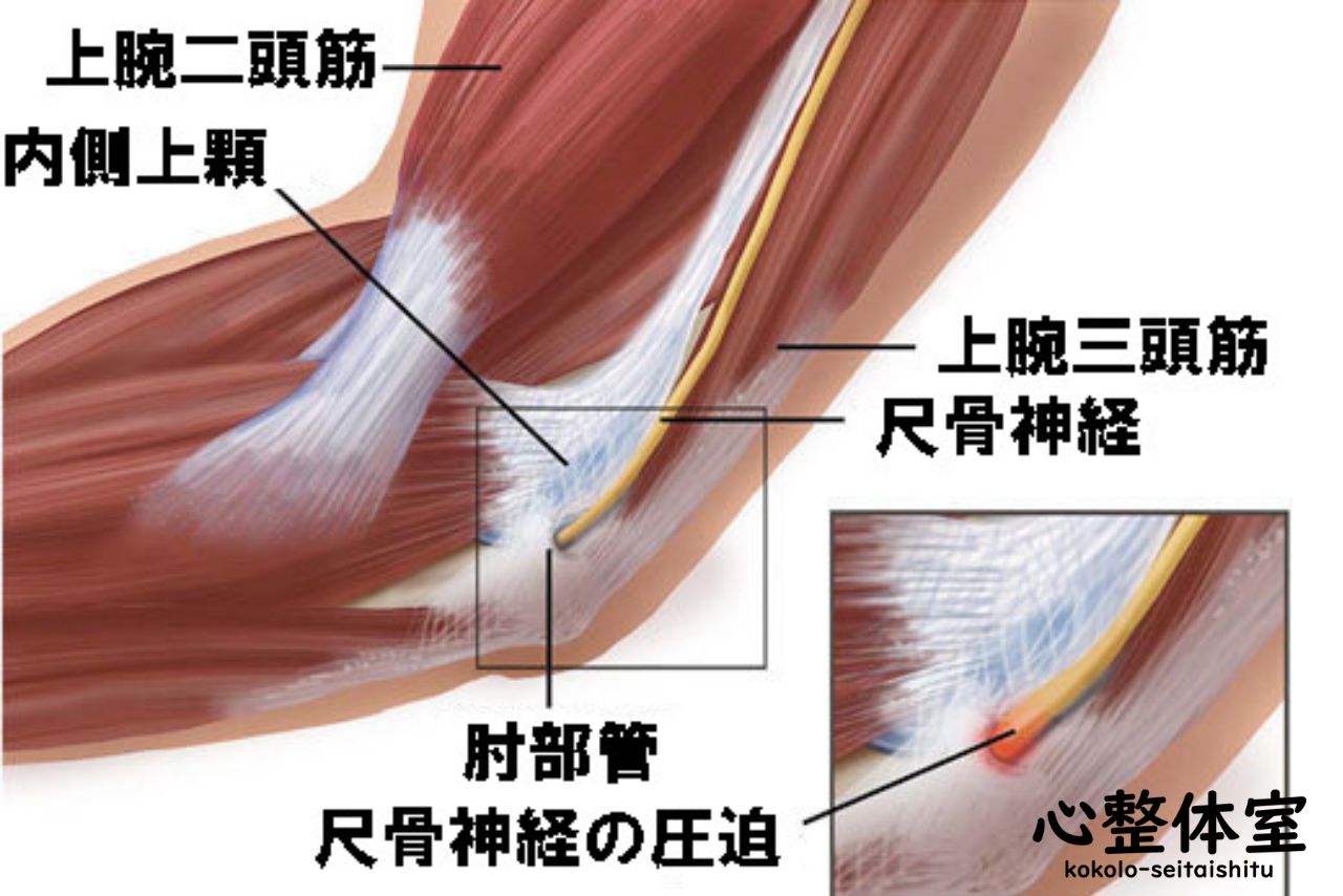 肘部管症候群