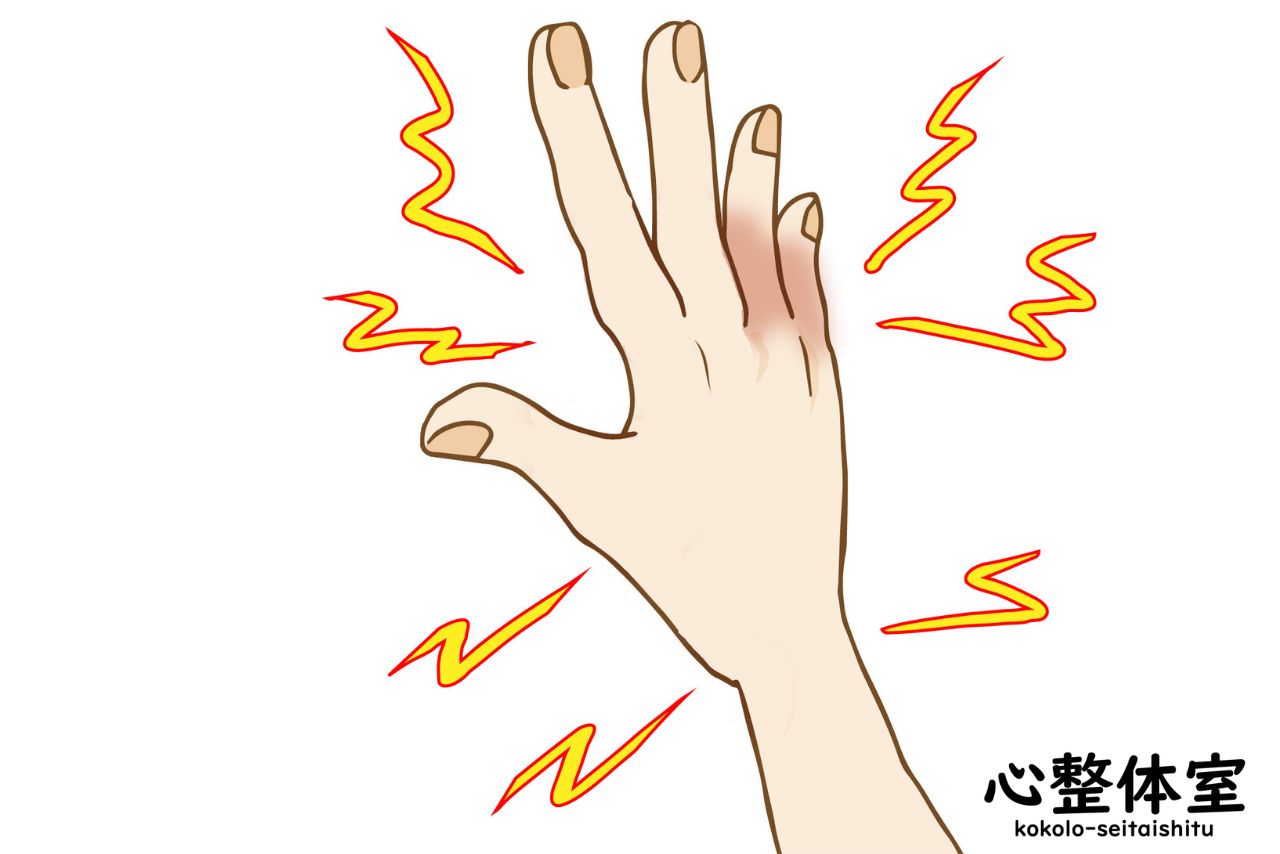 肘部管症候群からの薬指小指のシビレ
