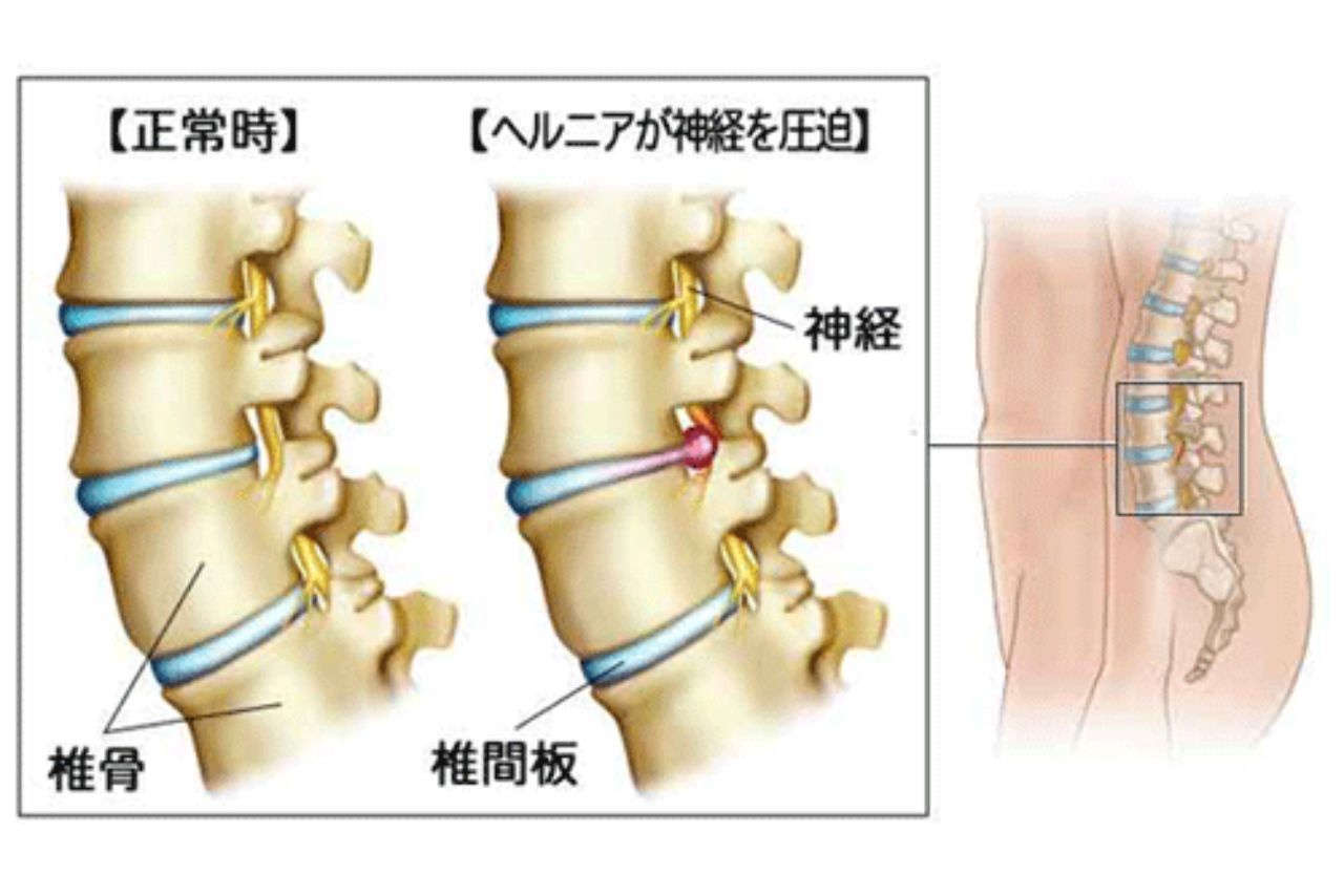 腰椎椎間板ヘルニア01