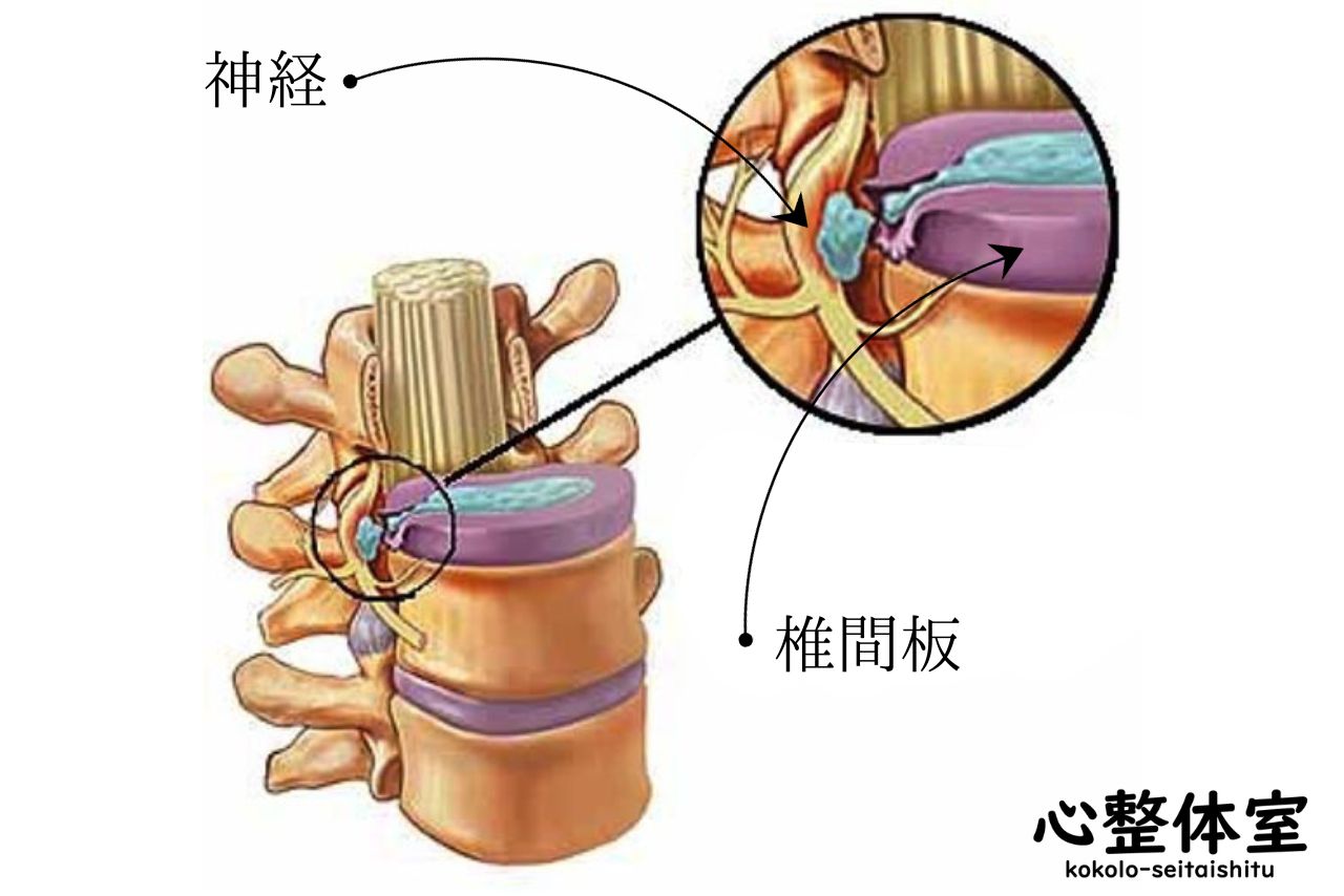 腰椎椎間板ヘルニア02