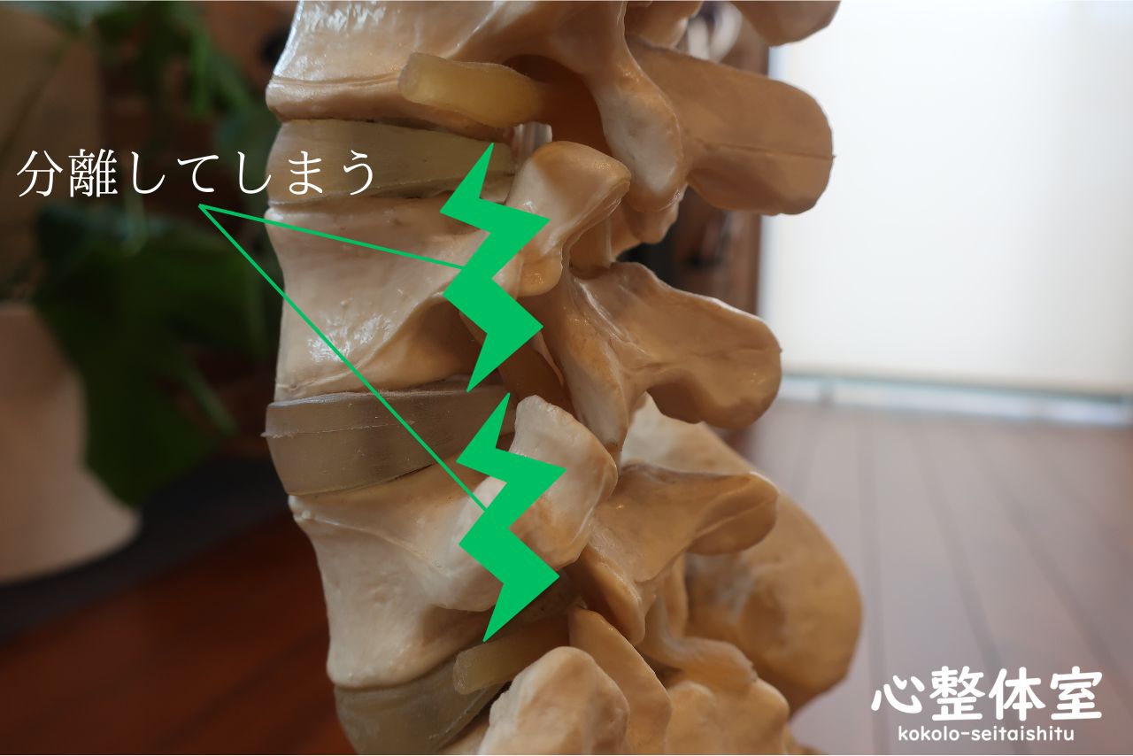 腰椎が分離・骨折