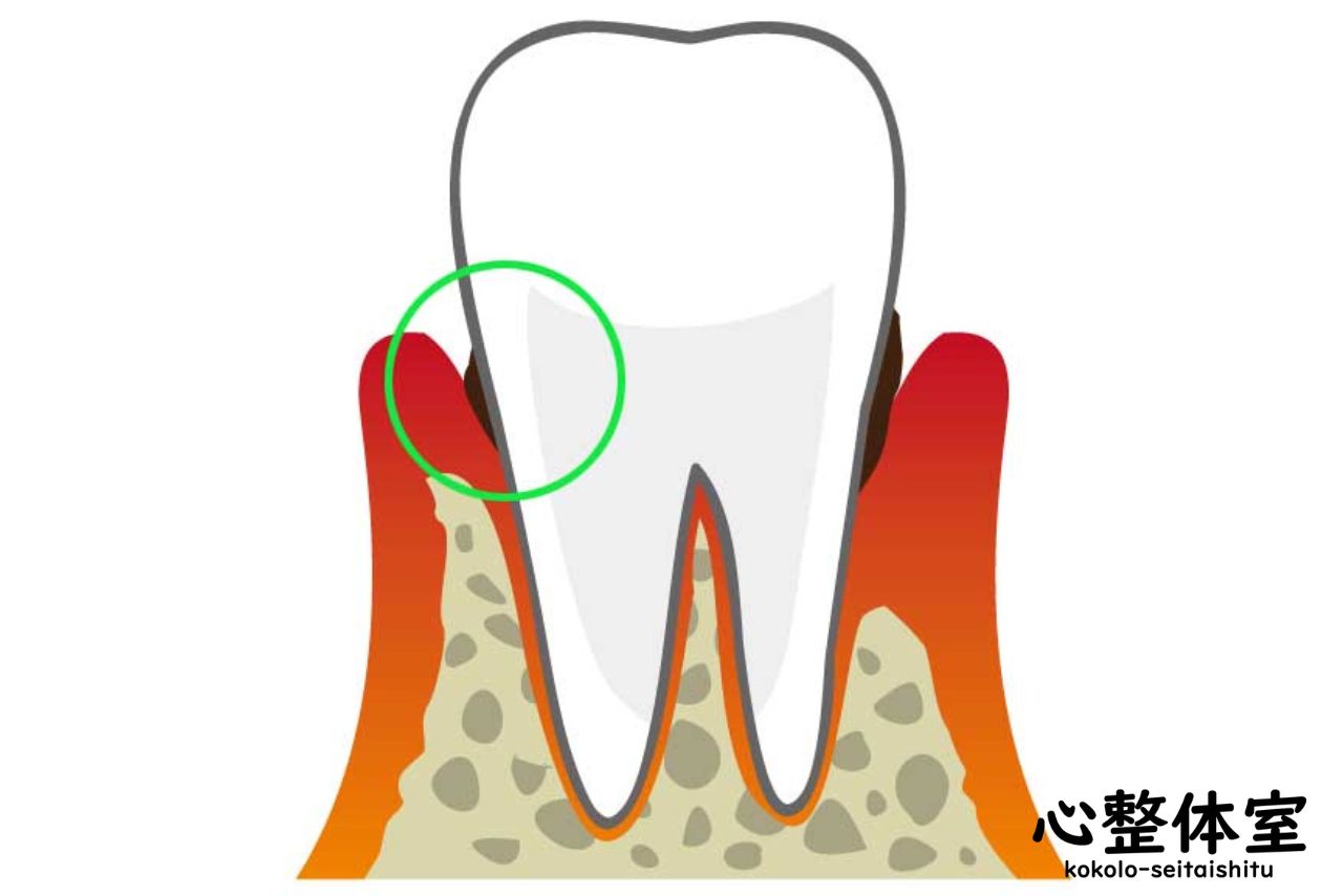 大人の虫歯は歯茎あたりから
